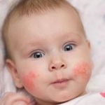 CMPA - cow milk allergy - babies - infants - cute baby with rashes