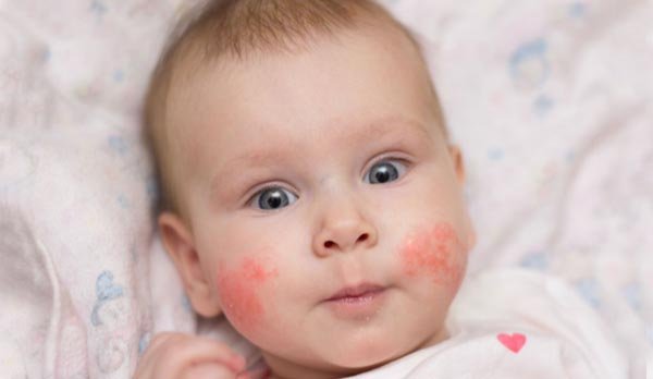 CMPA - cow milk allergy - babies - infants - cute baby with rashes