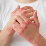 control psoriasis symptoms - skin disease - natural healing - boost immunity - Organique Acai Premium Blend - anti-itch