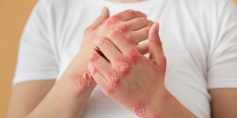 control psoriasis symptoms - skin disease - natural healing - boost immunity - Organique Acai Premium Blend - anti-itch