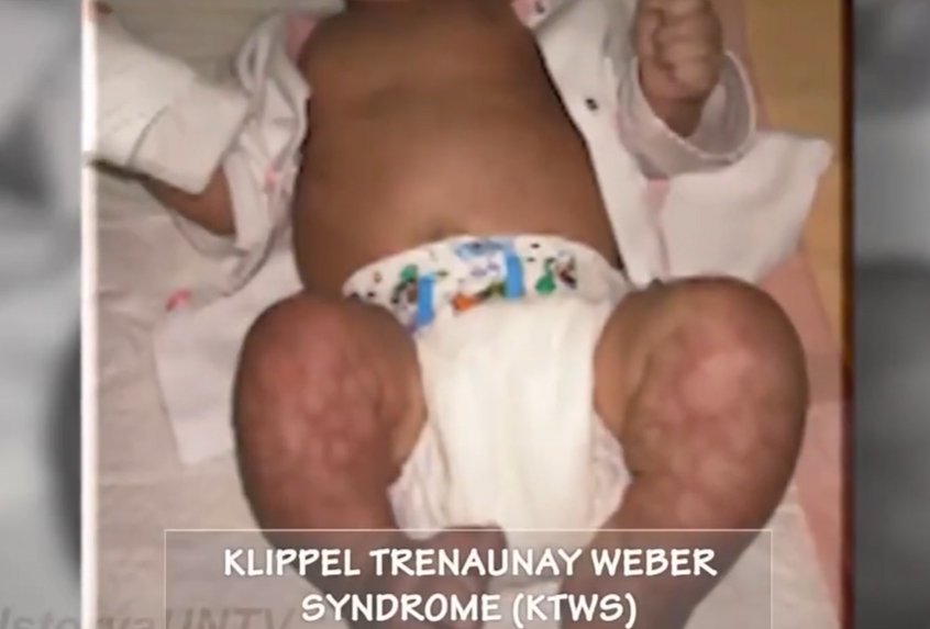 When Asha was born, her parents already knew that she was different.